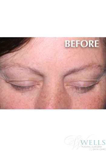 Before Image: Latisse - front