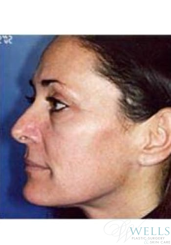 After Image: Microdermabrasion - left-side