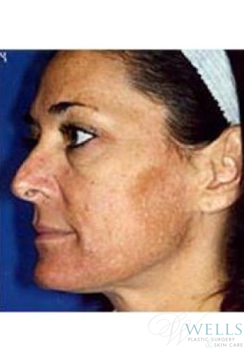 Before Image: Microdermabrasion - left-side