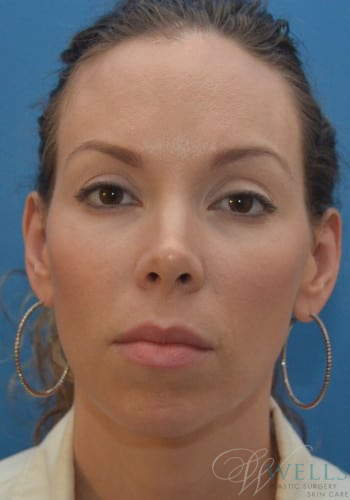 After Image: Otoplasty - front