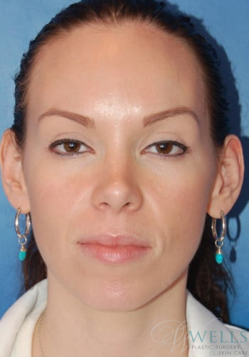 Before Image: Otoplasty - front