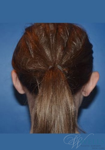 Before Image: Otoplasty - back