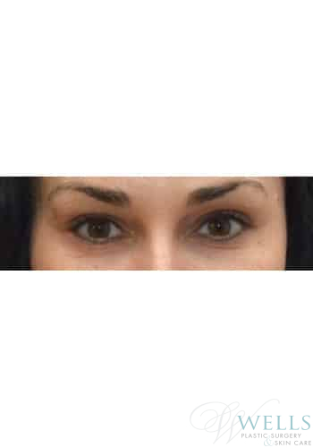 After Image: Microneedling - front