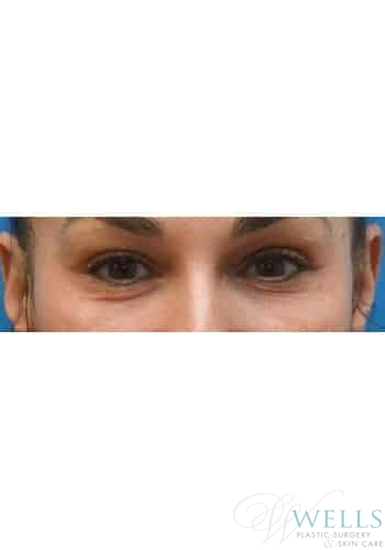 Before Image: Microneedling - front