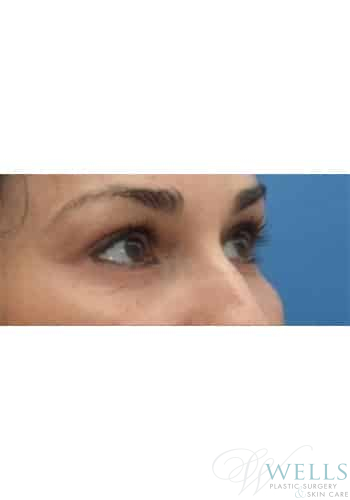 After Image: Microneedling - right-front-oblique