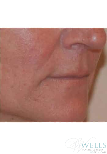 After Image: Fillers - right-front-oblique
