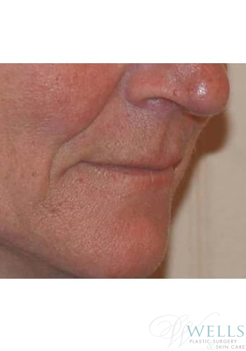 Before Image: Fillers - right-front-oblique