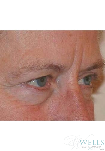 After Image: Fillers - right-front-oblique