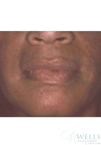 After Image: Fillers - front