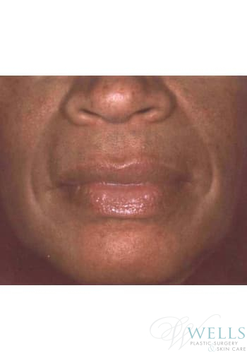 Before Image: Fillers - front