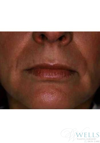 Before Image: Fillers - front
