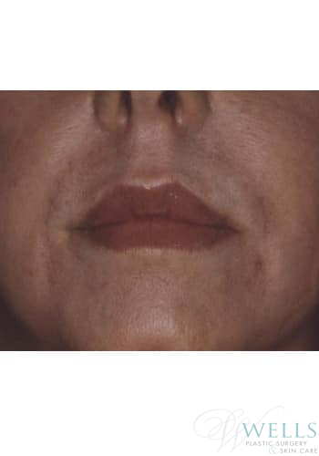 After Image: Fillers - front