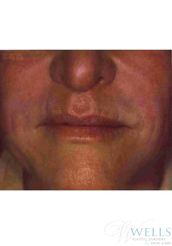 After Image: Fillers - front