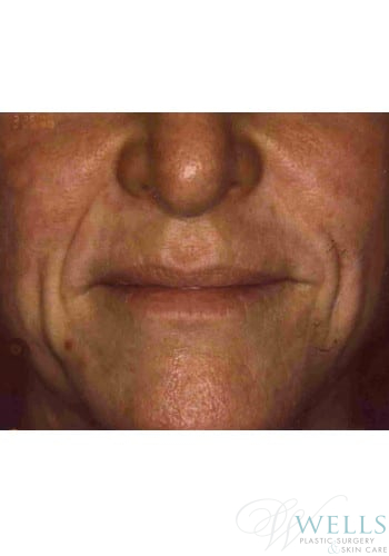 Before Image: Fillers - front