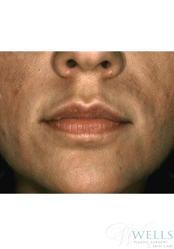 After Image: Fillers - front