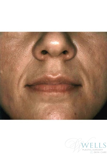 Before Image: Fillers - front