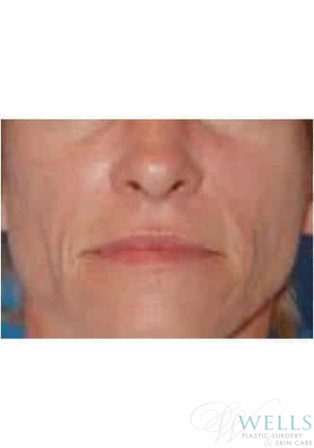 After Image: Fillers - front