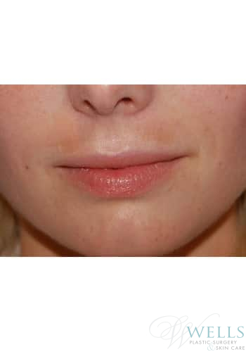 Before Image: Fillers - front