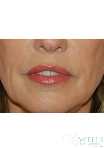 After Image: Fillers - front
