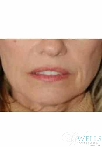 Before Image: Fillers - front