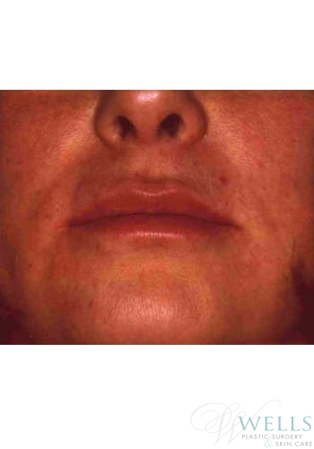 After Image: Fillers - front