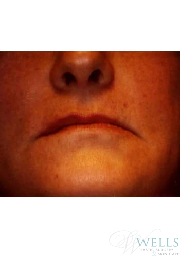 Before Image: Fillers - front