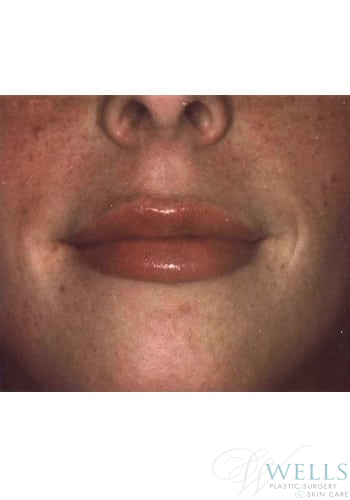 After Image: Fillers - front