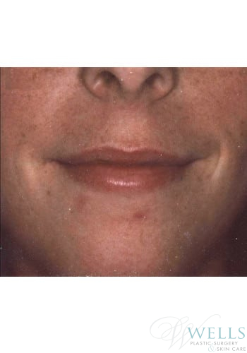 Before Image: Fillers - front