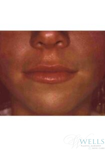 After Image: Fillers