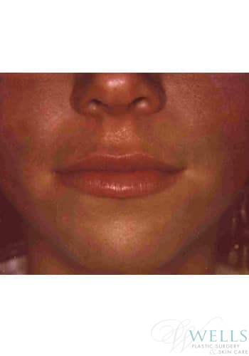 After Image: Fillers - front