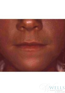 Before Image: Fillers