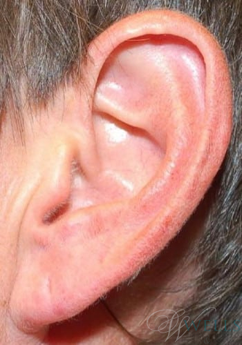 After Image: Fillers - other