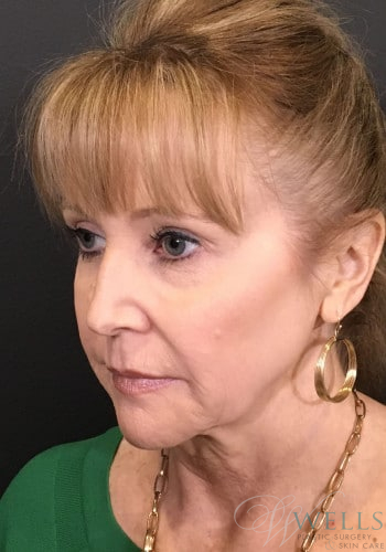 Before Image: Facelift - left-front-oblique