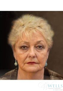 Before Image: Facelift