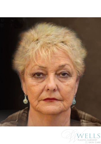 Before Image: Facelift - front
