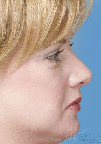 After Image: Rhinoplasty - right-side