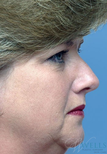 Before Image: Rhinoplasty - right-side