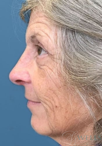 After Image: Rhinoplasty - left-side
