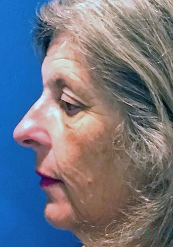 Before Image: Rhinoplasty - left-side