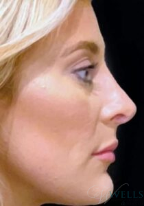 After Image: Rhinoplasty