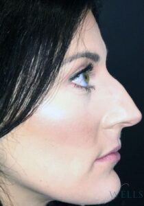 Before Image: Rhinoplasty