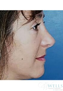 After Image: Rhinoplasty