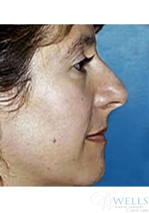 Before Image: Rhinoplasty