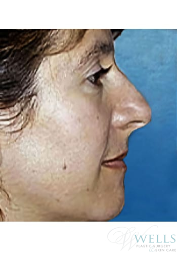 Before Image: Rhinoplasty - right-side