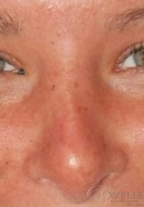 After Image: Rhinoplasty
