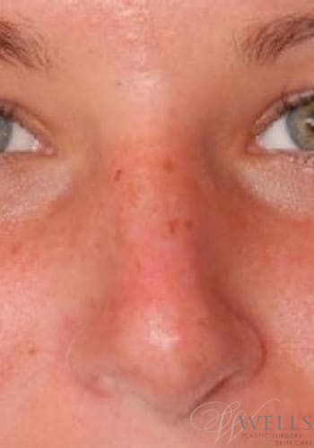 Before Image: Rhinoplasty - front