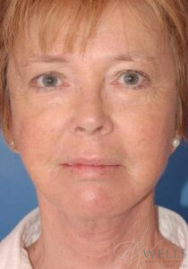 After Image: FACELIFT
