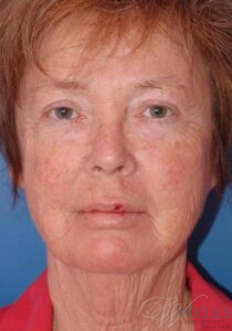 Before Image: FACELIFT