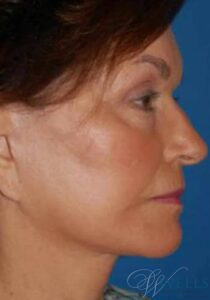 After Image: FACELIFT