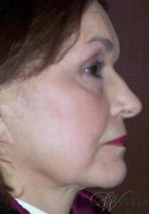 Before Image: FACELIFT